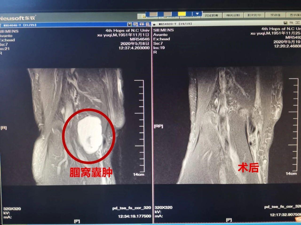 囊肿“潜伏”女子后背20余年 -长江航运总医院